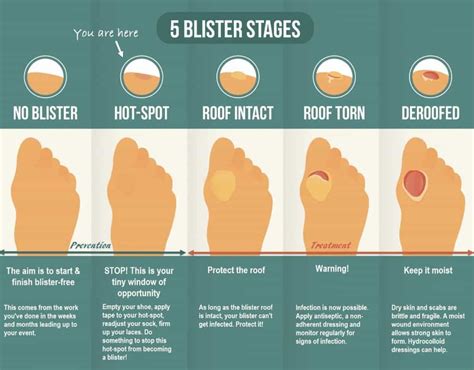 Divine Info About How To Treat Blisters On Foot - Matehope54