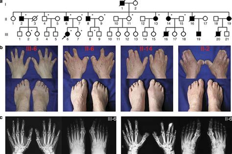 Pin on Mutations-Chromosome abnormalities and Developmental errors