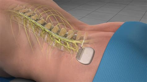 Dorsal Column Spinal Cord Stimulator Implant - Empire Spine and Pain