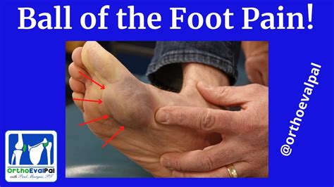 Ball of the Foot Pain - YouTube