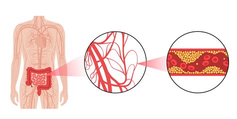 Isquemia arterial mesentérica | Centro Médico ABC