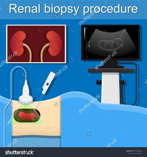 Renal Biopsy Procedure Kidney Tissue Lab Stock Vector (Royalty Free) 1083786620 | Shutterstock