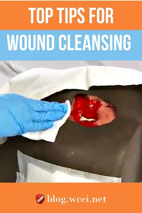 Are your wound-cleansing practices up-to-date? Find out with these top ...