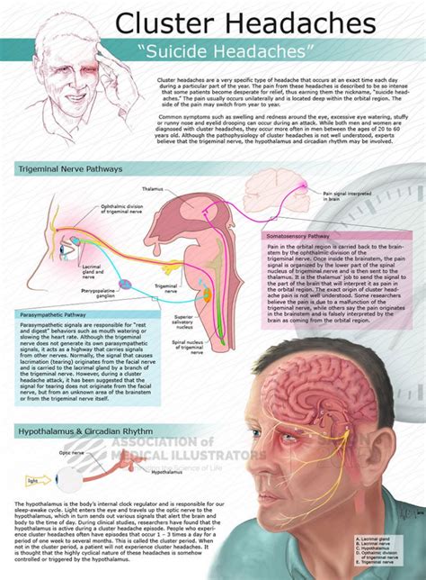 Infographic : Cluster Headaches " Suicide Headaches