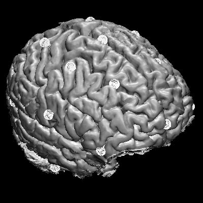 3D image of a brain obtained from MRI. The markers show the end points ...