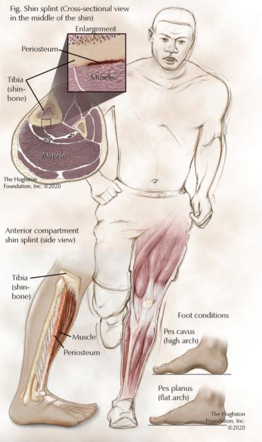 How to Manage Shin Splints - Hughston Clinic