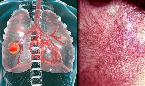 Lung cancer symptoms: Signs of tumour include itchy skin rash pain | Express.co.uk