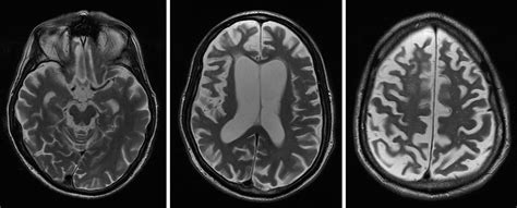 Irresti: Corticobasal Degeneration Mri Brain