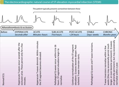 Figure 2. The electrocardiographic natural course in STEMI (STE-ACS). – ECG learning