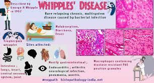 Google Image Result | Whipple's disease, Pathology, Disease