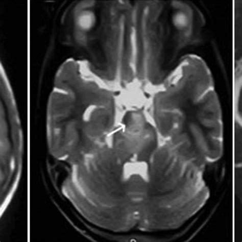 MRI T1-weighted image (a) showing the hypointense well-defined lesion... | Download Scientific ...