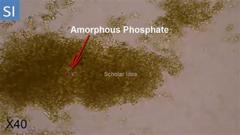 Amorphous Urates In Urine