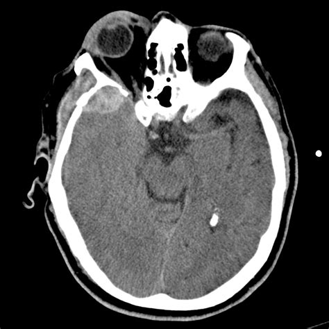 Is this extra-axial hematoma due to arterial or venous hemorrhage?