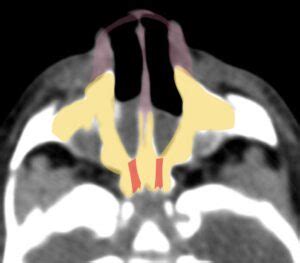 Choanal Atresia - NeuroRad911 Choanal Atresia