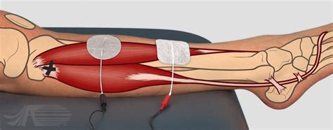 Ankle Dorsiflexion