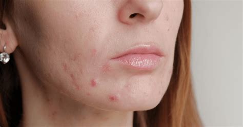 Is acne a menopause symptom? | A.Vogel Talks Menopause