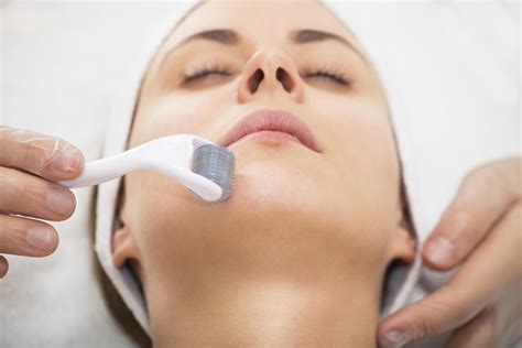 Microneedling – Eine ideale Methode zur Verjüngung der Haut und zur Behandlung von Aknenarben