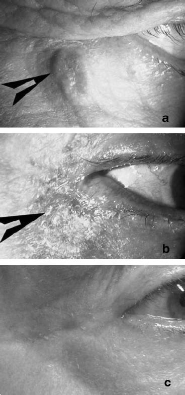 Image of nodular basal cell carcinoma on left lower eyelid margin of ...