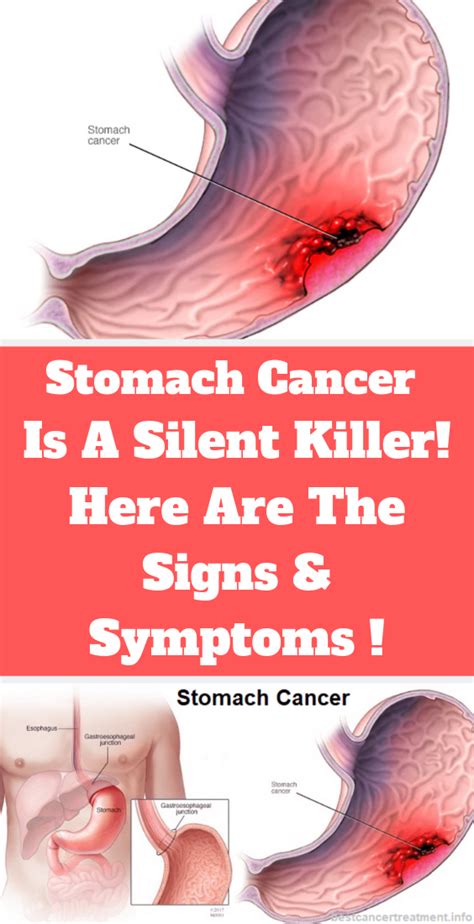 Signs And Symptoms of Stomach Cancer ! | Wellness Brief