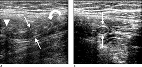 Normal Appendix Ultrasound