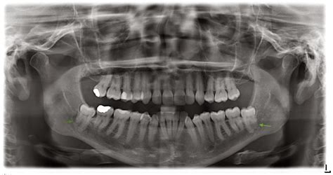 Coronectomy