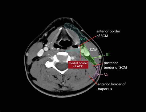 The Radiology Assistant : Cervical Lymph Node Map (2024)