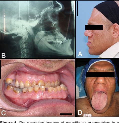 [PDF] Correction of Mandibular Prognathism by Orthognathic Surgery in a Patient with Acromegaly ...