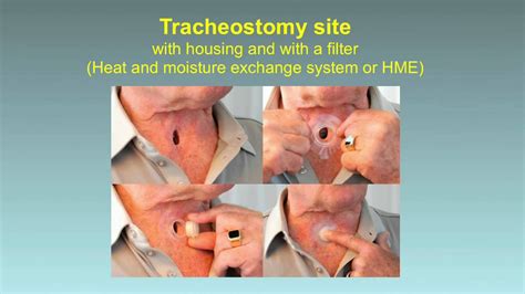 Rescue Breathing for Laryngectomees and Neck Breathers - YouTube