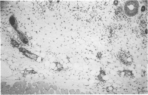 Histology of the Arthus reaction in skin, treated with PBS (positive... | Download Scientific ...