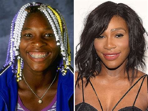 Serena Williams Before and After Plastic Surgery