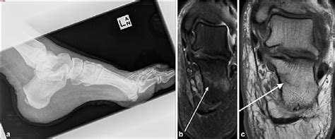 (a) Lateral radiograph of the left foot demonstrates a posterior... | Download Scientific Diagram