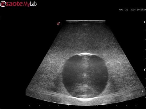 Abscess Drainage Ultrasound Training Model – GTSimulators.com