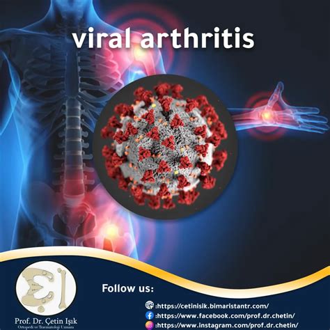 viral arthritis; Symptoms and management - Dr. How are you?