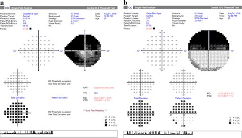 Right eye HVF (a 30-2, b 10-2) showing a complete bi-arcuate scotoma ...