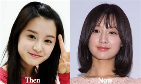 Kim Ji Won Plastic Surgery Before and After Photos - Latest Plastic ...