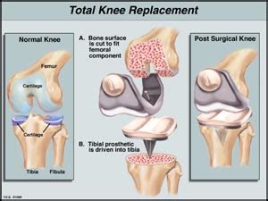 Computer Assisted Knee Replacement | New Orleans orthopedic surgeons