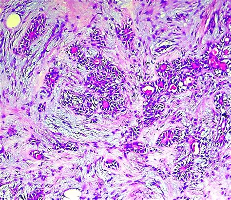 Pathology Outlines - Pleomorphic adenoma