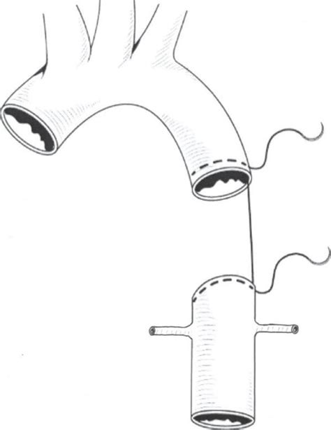 Resection and end-to-end anastomosis. | Download Scientific Diagram