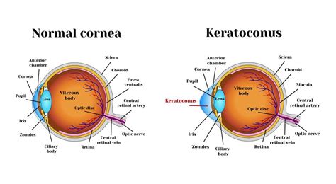 Keratoconus and Astigmatism - drholzman