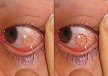 Chemosis - Wikipedia