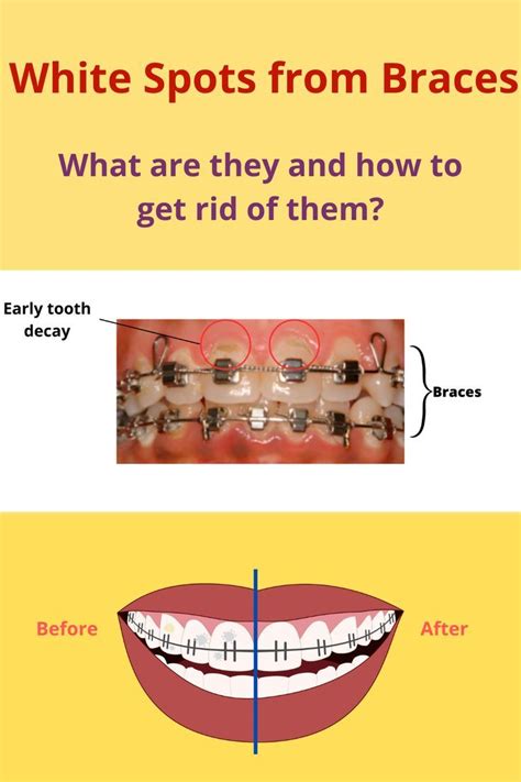 White spots from braces Teeth After Braces, Braces Before And After, White Teeth, Tooth Decay ...