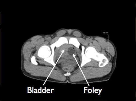 Collapsed urinary bladder. The urinary bladder is relatively collapsed ...