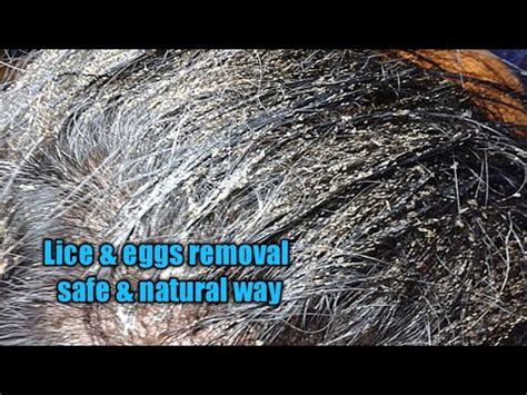 Head lice & eggs removal safe and natural way/head lice & nits ...