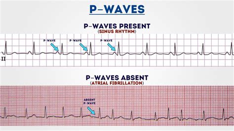 Pin on Ekg interpretation