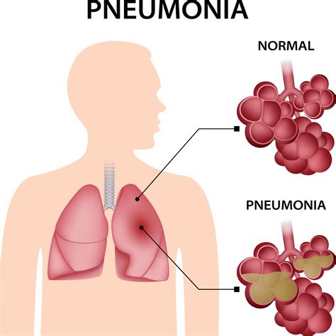 Pneumonia Treatment At Home