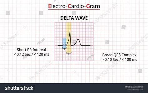 Delta Wave Ecg Morphology Electrocardiogram Vector Stock Vector (Royalty Free) 2283365495 ...