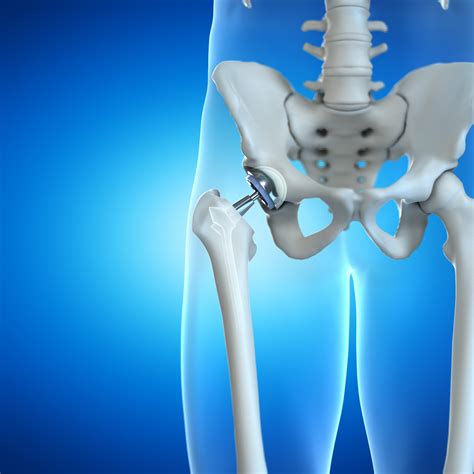 hip joint replacement | Fairfield Medical Center