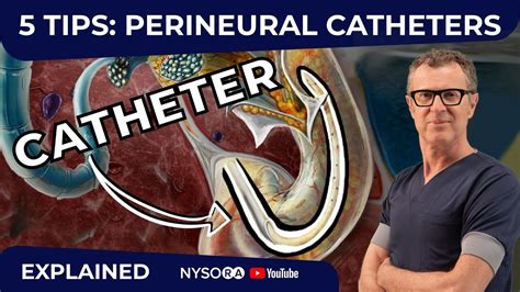 5 TIPS: PERINEURAL CATHETERS - Crash course with Dr. Hadzic - YouTube