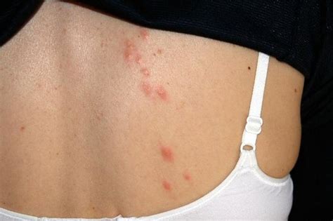 flea bites rash - pictures, photos