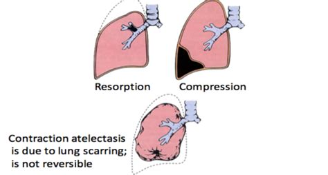 Lung Pathology I and II Flashcards | Quizlet